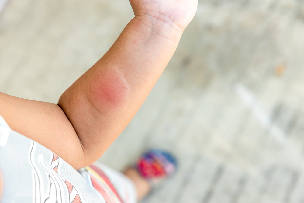 Allergische reactie op een muggenbult bij kinderen: wat moet je weten?